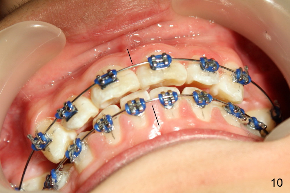 Maxillary protrusion is treated with extraction and ortho, Dental